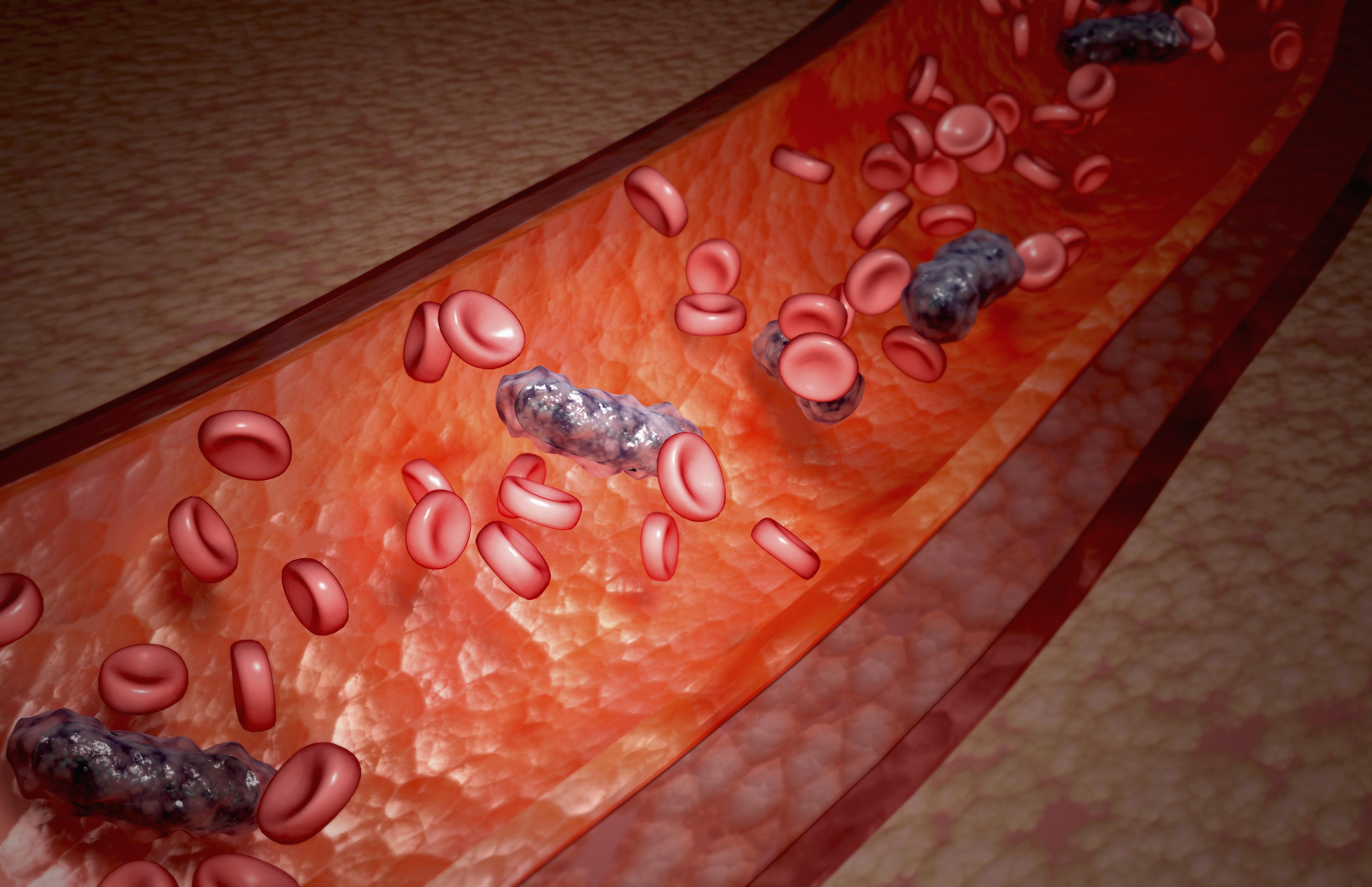 trombosis-venosa-importancia-de-la-anticoagulaci-n-y-la-covid-19